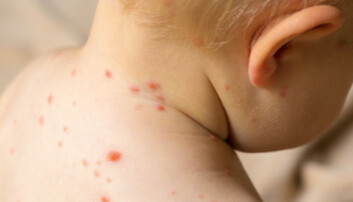 Vaksinemotstandere får skylda for 30 prosent økning i meslinger blant barn