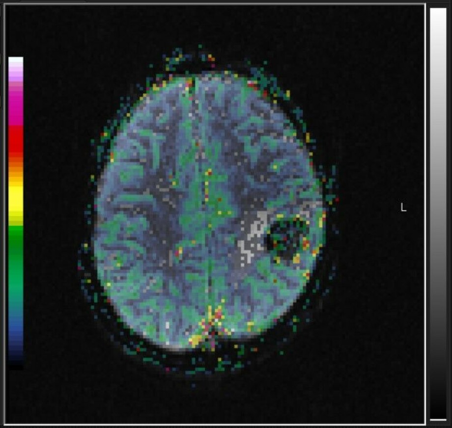 Fargeskalaen i bildet viser volumet av blod i hvert område i hjernen og er lagt på toppen av svart-hvitt bildet.