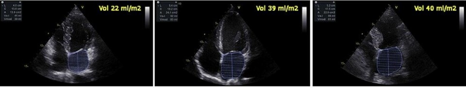 Ultralydbilde av hjertet, venstre forkammer er skravert. Sett fra venstre: 1) normal størrelse, 2) forstørret hos idrettsutøver, 3) forstørret hos hjertesyk. Bildet er modifisert av artikkelforfatteren.