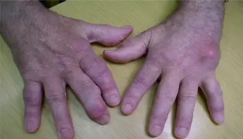 Bildet viser en stor urinsyreavleiring på hånden til høyre og flere mindre avleiringer på langfingeren på hånden til venstre.