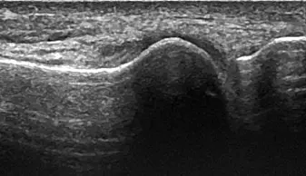 Bildet øverst viser ultralydbilde av et normalt stortåledd, mens bildet under viser ultralydbilde av et stortåledd med avleiringer.