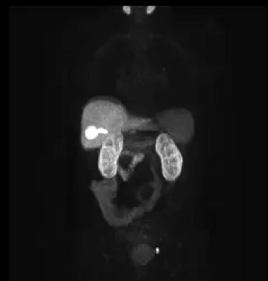 Her ser vi PSMA-PET-bilder av bekkenområde til en pasient med mistanke om tilbakefall etter prostatakreft. På bildet ser vi hvor PSMA -raceren blir tatt opp i kroppen, med blant annet mye opptak i nyre, lever og spyttkjertler for friskt vev. Den lille, runde og lyssterke flekken i bunn av bilde viser tegn på tilbakefall av kreftsykdom.