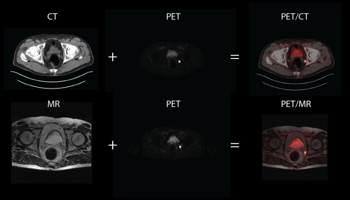 På bildene ser vi MR- og CT-bilder av snitt av bekkenområde til en pasient med mistanke om tilbakefall etter prostatakreft. Det er vanskelig se anatomisk informasjon ut av PET-bildene og de fusjoneres derfor sammen med MR. og CT.bilder. I bekkenområdet, som består av mye bløtvev, gir MR mer informasjon enn CT. På bildene ser vi MR- og CT-bilder av snitt av bekkenområde til en pasient med mistanke om tilbakefall etter prostatakreft. Det er vanskelig se anatomisk informasjon ut av PET-bildene og de fusjoneres derfor sammen med MR. og CT.bilder. I bekkenområdet, som består av mye bløtvev, gir MR mer informasjon enn CT.
