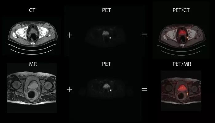 På bildene ser vi MR- og CT-bilder av snitt av bekkenområde til en pasient med mistanke om tilbakefall etter prostatakreft. Det er vanskelig se anatomisk informasjon ut av PET-bildene og de fusjoneres derfor sammen med MR. og CT.bilder. I bekkenområdet, som består av mye bløtvev, gir MR mer informasjon enn CT.