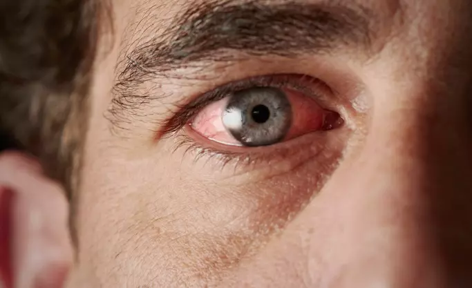 Maskinlæring kan bedre diagnostisering og behandling av tørre øyne