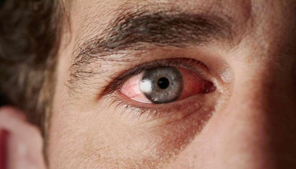 Sykdommen tørre øyne kan føre til redusert livskvalitet og nedsatt arbeidskapasitet, men kan være vanskelig å diagnostisere. Nye metoder viser potensial, skriver doktorgradsstipendiat Andrea Storås.