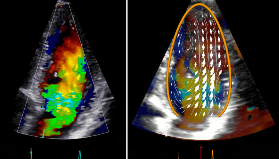 Blodstrømmen i venstre hovedkammer i hjertet avbildet med vanlig Dopplerteknologi til venstre, og med «Blood Speckle Tracking» til høyre.
