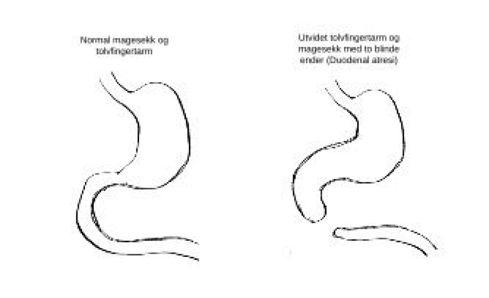Fem Av Hundre Barn F des Med En Misdannelse Hvordan Skjer Det Og fem-av-hundre-barn-f-des-med-en-misdannelse-hvordan-skjer-det-og